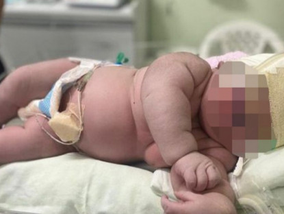 Gia đình - Bé sơ sinh chào đời nặng 7.3kg, gần bằng trẻ 1 tuổi khiến ê-kíp đỡ đẻ ngỡ ngàng