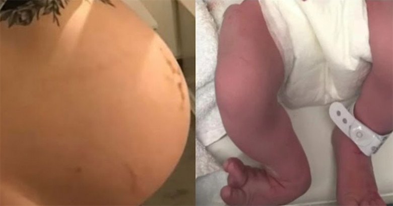 Mẹ bầu tưởng bàn chân thai nhi bị đạp nên đau xương sườn, bác sĩ kết luận bất ngờ - 2