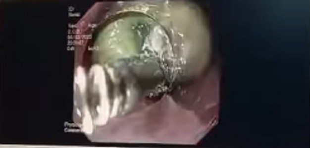 Sản phụ nguy kịch vì nuốt mật lợn sống sau sinh để ngừa đau bụng, chuyên gia lên tiếng cảnh báo - 1