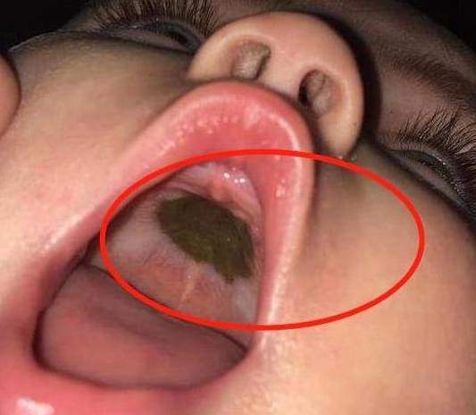 Phát hiện đốm đen kỳ lạ trong miệng con, mẹ lập tức đi khám, bác sĩ nói: Thật đáng mừng! - 1