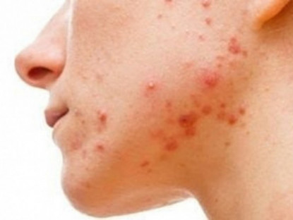 Y tế - Cảnh báo mụn có thể là dấu hiệu của bệnh thận giai đoạn cuối