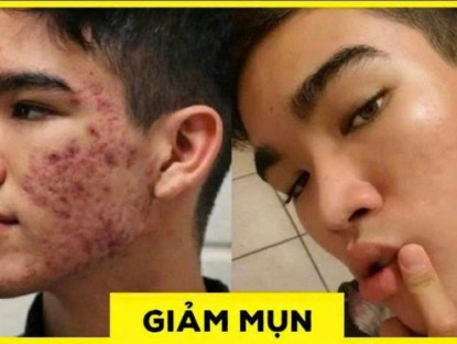 Thông tin doanh nghiệp - Đàn ông con trai bị mụn: Chấm dung dịch này mỗi tối là sạch sẽ, không cần đi Spa với bôi kem như con gái