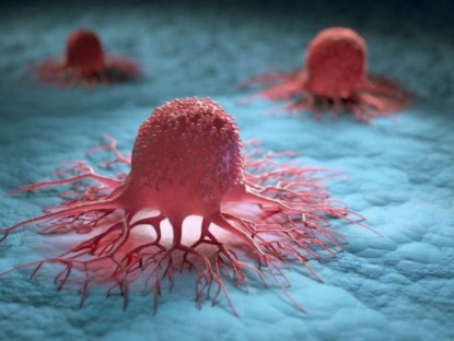 Thông tin doanh nghiệp - 3 nguyên tắc vàng hạn chế sự phát triển của khối u