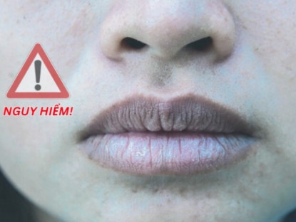 Thông tin doanh nghiệp - 3 dấu hiệu trên mặt cảnh báo phổi “gặp hạn”, đừng chậm trễ kẻo “tử thần gõ cửa”!