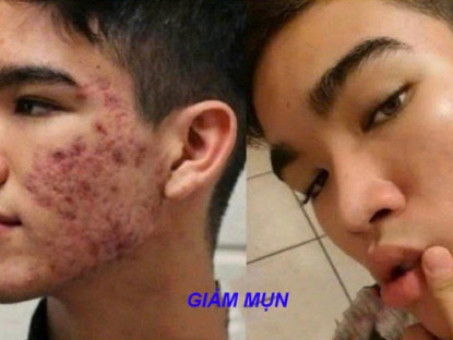Thông tin doanh nghiệp - Đàn ông con trai bị mụn: Chấm dung dịch này mỗi tối là sạch sẽ, không cần đi Spa với bôi kem như con gái