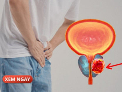 Thông tin doanh nghiệp - 5 đối tượng có khả năng cao mắc phì đại tuyến tiền liệt khi về già, nam giới chớ chủ quan
