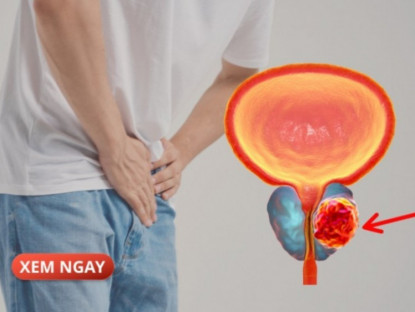 Thông tin doanh nghiệp - 5 đối tượng có khả năng cao mắc phì đại tuyến tiền liệt khi về già, nam giới chớ chủ quan