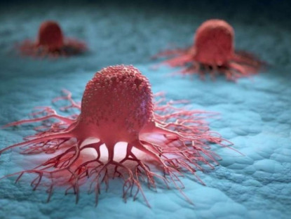 Thông tin doanh nghiệp - 3 nguyên tắc vàng ngăn sự hình thành khối u