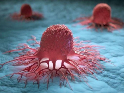 Thông tin doanh nghiệp - 3 nguyên tắc vàng ngăn sự hình thành khối u