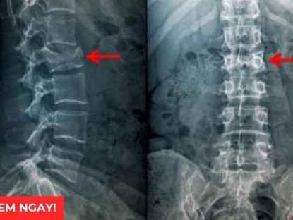 Thông tin doanh nghiệp - 3 tư thế ngủ tốt nhất giúp giảm đau rõ rệt cho người bị thoái hóa cột sống