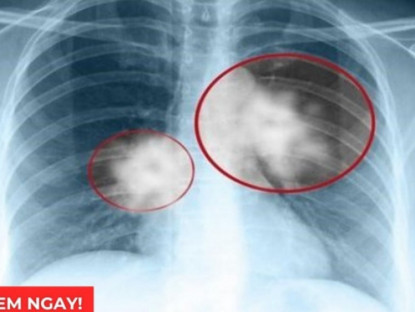 Thông tin doanh nghiệp - Tư thế ngủ tốt nhất cho phổi giúp giảm đàm ho, thở dễ hơn: Nhiều người đang làm sai!