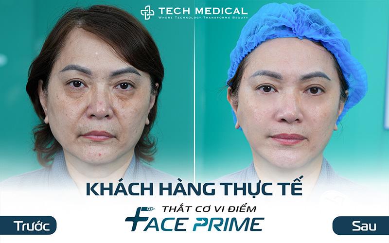 Thắt cơ vi điểm, giải pháp trẻ hóa được nhiều chị em Việt Kiều lựa chọn - 2