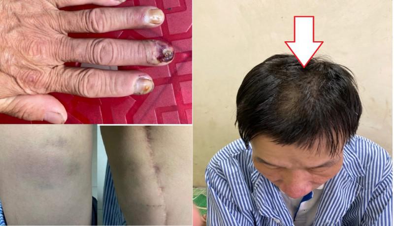 Vĩnh Tuy (Bắc Quang – Hà Giang): Cần làm rõ hành vi đánh đập dã man công dân với lý do sai sót nghiệp vụ? - 1