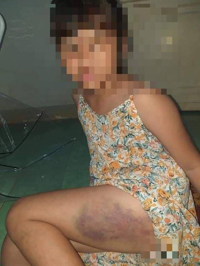 Tạm đình chỉ cô giáo đánh tím đùi học sinh lớp 3 ở Đắk Lắk - 1