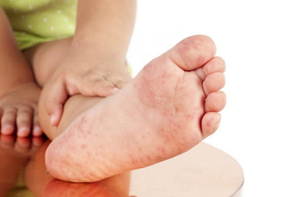 Phân độ chân tay miệng ở trẻ em như thế nào? - 4