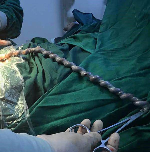 Em bé chào đời dây rốn xoắn tít như lò xo, bác sĩ lắc đầu: "Sao nghịch quá?" - 2