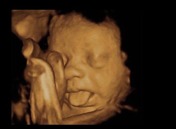 Cử chỉ chưa từng thấy của thai nhi trong lúc siêu âm khiến bố mẹ giật mình - 2