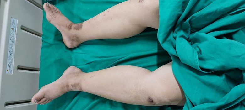 Thai phụ Tuyên Quang nguy kịch vì chủ quan khi bị phù chân, sinh bé gái nặng 4.3kg - 1