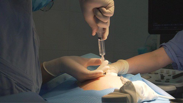 Mẹ bầu 32 tuần cạn ối khiến tử cung bó chặt, thai nhi nằm co như bị hút chân không - 1