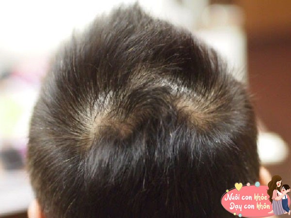 99% trẻ có hai xoáy tóc trên đầu sẽ thông minh hơn người? Khoa học đưa ra giải thích bất ngờ - 2