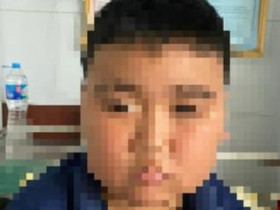 Bé trai 13 tuổi bị suy tuyến thượng thận vì dùng thuốc sai cách