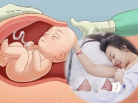 Phương Oanh sinh mổ đón 2 bé rồng: Tại sao thai đôi nên sinh mổ và khi nào có thể sinh thường?