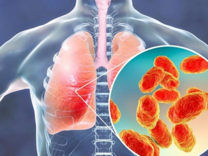 Xã hội - Bác sĩ Bệnh viện K cảnh báo 5 dấu hiệu cảnh báo ung thư phổi