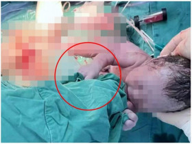 Khoảnh khắc hiếm: Hành động của em bé khi vừa chào đời khiến cả phòng sinh rưng rưng nước mắt