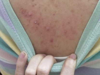 Thông tin doanh nghiệp - Viêm nang lông, mụn sần sùi khắp lưng, chân, tay: Thử nhiều cách không hết mà làm đúng mẹo này là sạch bách