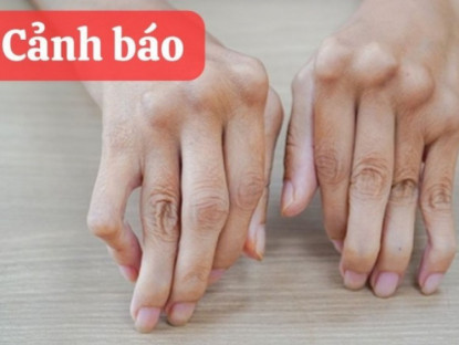 Thông tin doanh nghiệp - Đừng coi thường cơn đau khớp lúc trái gió trở trời – Có thể là dấu hiệu tàn phế sớm!