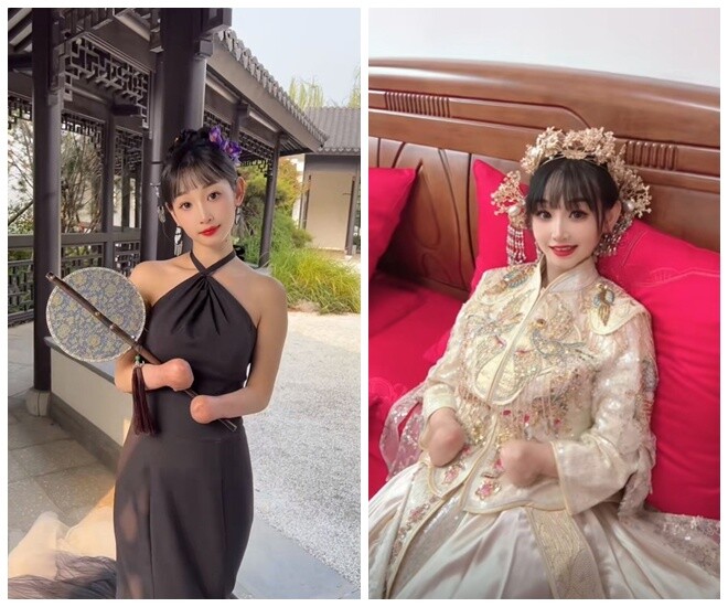 Bị miệt thị sẽ sinh ra &#34;quái thai&#34;, mẹ bầu trẻ không tay vẫn được chồng chiều như bà hoàng - 1