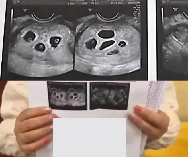 Đến bệnh viện siêu âm, cô gái 18 tuổi tá hoả khi bác sĩ thông báo đang mang thai 8 bé - 2