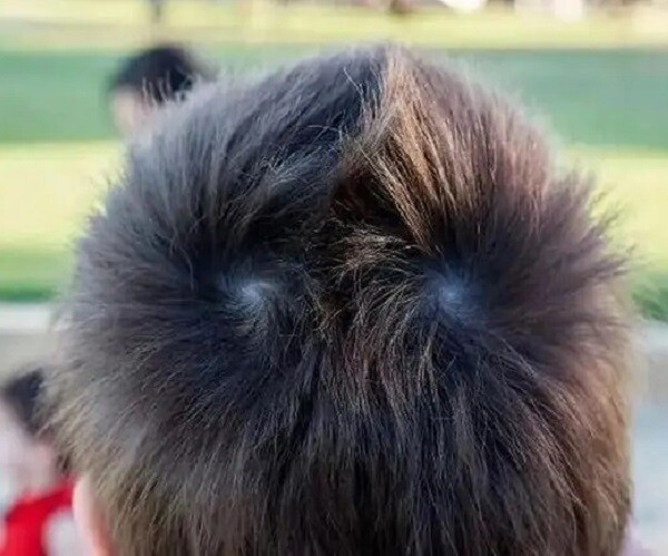 Trẻ có hai xoáy trên đầu sẽ khó nuôi? Nghiên cứu khoa học tiết lộ sự thật - 1