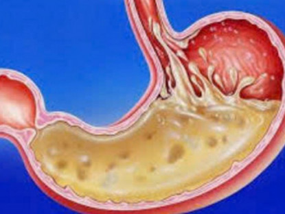 Thông tin doanh nghiệp - Những nguy hiểm mà người bị trào ngược dạ dày nhất định phải biết nếu không xử lý đúng cách