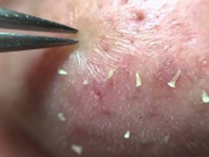 Thông tin doanh nghiệp - Mụn con trai có cơ chế khác biệt, cần xử lý bằng cách này thay vì bôi kem và đi Spa như con gái