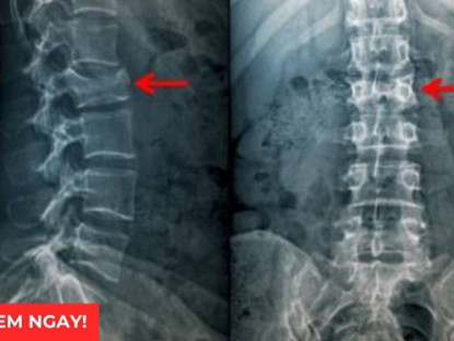 Thông tin doanh nghiệp - 3 tư thế ngủ tốt nhất giúp giảm đau rõ rệt cho người bị thoái hóa cột sống