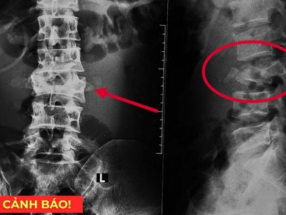 Thông tin doanh nghiệp - 5 thói quen tàn phá xương khớp cực nhanh, nên bỏ càng sớm càng tốt