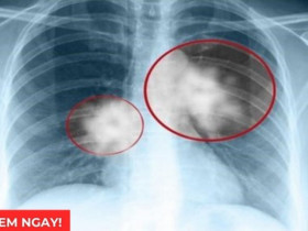 Tư thế ngủ tốt nhất giúp giảm đàm ho rõ rệt, thở dễ hơn: Nhiều người đang làm sai!