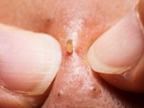 Hóa ra đây là cách xử lý mụn viêm của con trai: Không cần phải bôi kem mụn như con gái