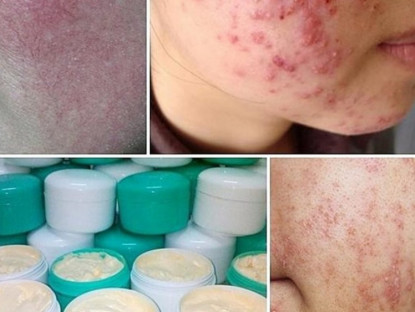 Thông tin doanh nghiệp - Sau Hydroquinone, người dùng nên kỳ vọng gì ở một sản phẩm làm sáng da lành tính?