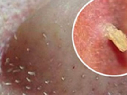 Thông tin doanh nghiệp - Đàn ông con trai bị mụn: Chấm dung dịch này mỗi tối là sạch, không cần đi Spa với bôi kem như con gái