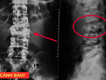 Thông tin doanh nghiệp - 5 thói quen tàn phá xương khớp cực nhanh, nên bỏ càng sớm càng tốt