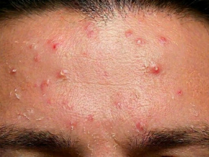 Thông tin doanh nghiệp - Cấp ẩm đúng cách cho da dầu mụn: Bí quyết giúp da cân bằng và hạn chế nổi mụn