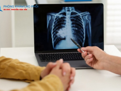 Thông tin doanh nghiệp - Phác đồ điều trị lao phổi chuẩn Bộ Y tế: Tuân thủ đúng để tránh lao kháng thuốc
