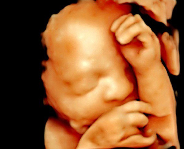 Mẹ khám thai đầy đủ vẫn sinh con dị tật, những vấn đề nào của thai nhi siêu âm không thể phát hiện? - 2
