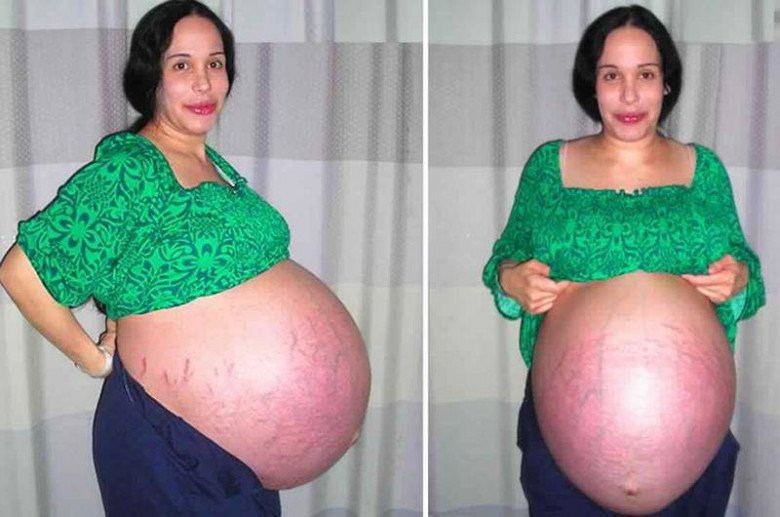 Mang thai 8, mẹ bầu gãy xương sườn khi sinh &#34;đàn con&#34; gây chấn động thế giới - 2