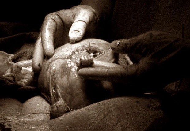 Thai nhi 21 tuần tuổi thò tay ra khỏi tử cung nắm tay bác sĩ, 23 năm sau có cuộc sống đáng ngưỡng mộ - 1