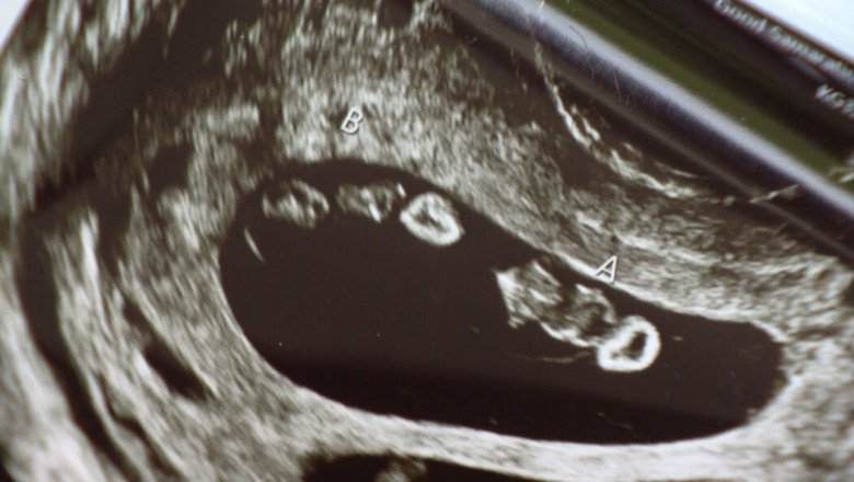 Mẹ sinh cùng lúc 2 cặp song thai, bác sĩ tấm tắc 70 triệu ca mới có một - 2