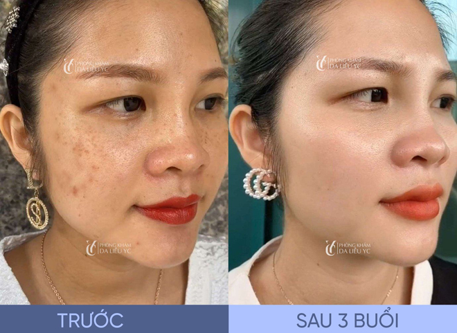 Công nghệ trị nám Nanocell Melasma tại Phòng khám Da liễu Quốc tế YC có ưu điểm vượt trội gì? - 4