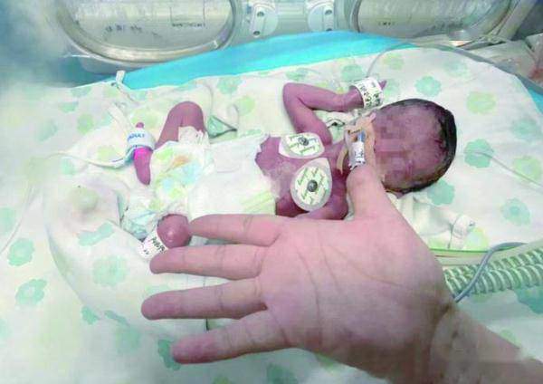 Chào đời nặng vỏn vẹn 6 lạng, bé gái tạo ra kì tích sau 3 tháng nằm viện - 1